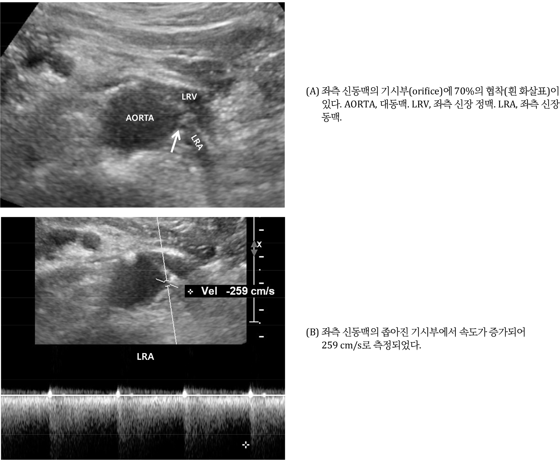 https://cdn.apub.kr/journalsite/sites/urology/2023-004-01/N0050040102/images/urology_04_01_02_F4.jpg