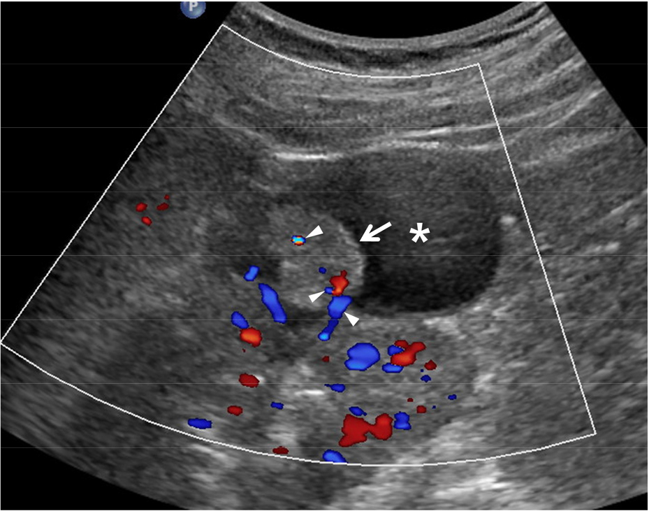 https://cdn.apub.kr/journalsite/sites/urology/2023-004-01/N0050040102/images/urology_04_01_02_F5.jpg