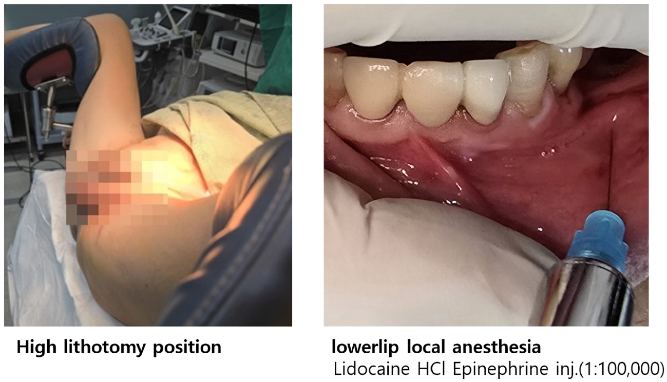 https://cdn.apub.kr/journalsite/sites/urology/2025-006-01/N0050060105/images/urology_06_01_05_F3.jpg