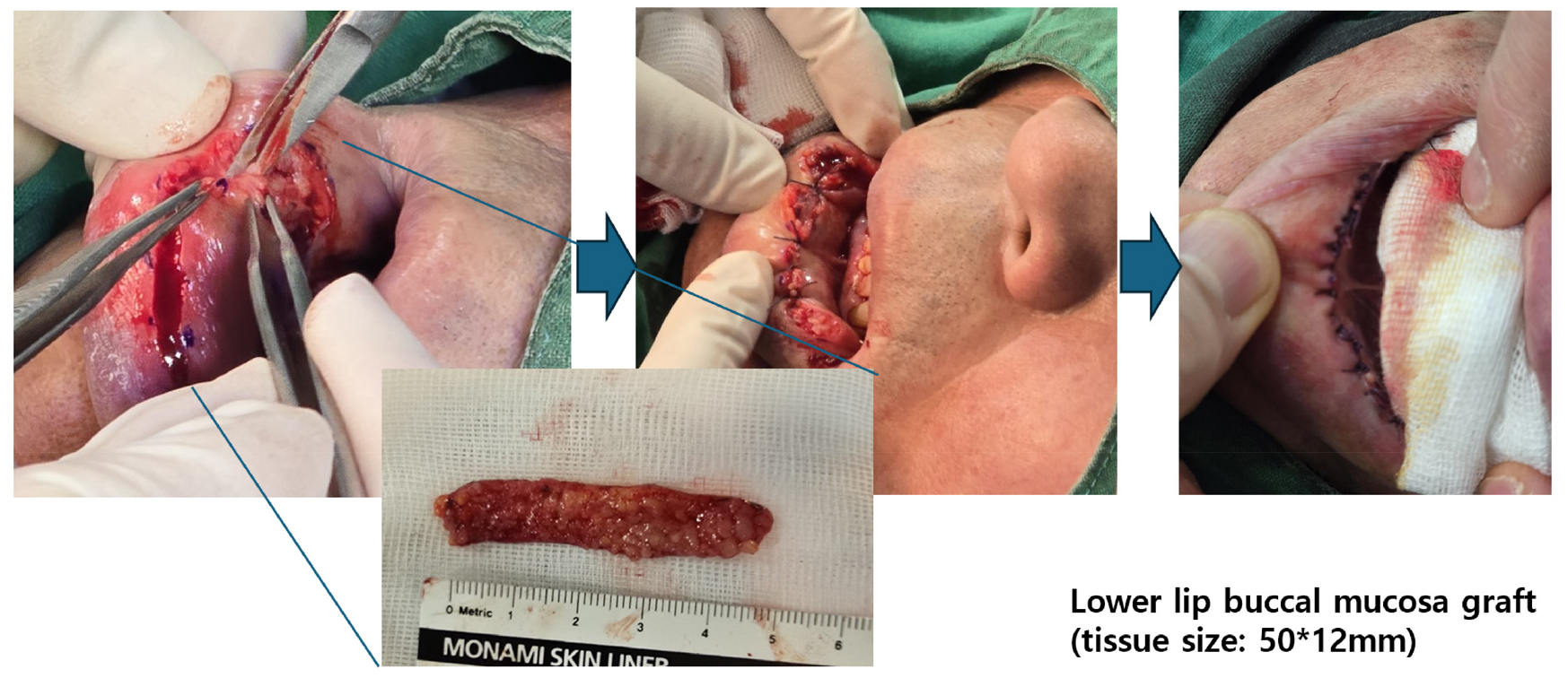 https://cdn.apub.kr/journalsite/sites/urology/2025-006-01/N0050060105/images/urology_06_01_05_F6.jpg