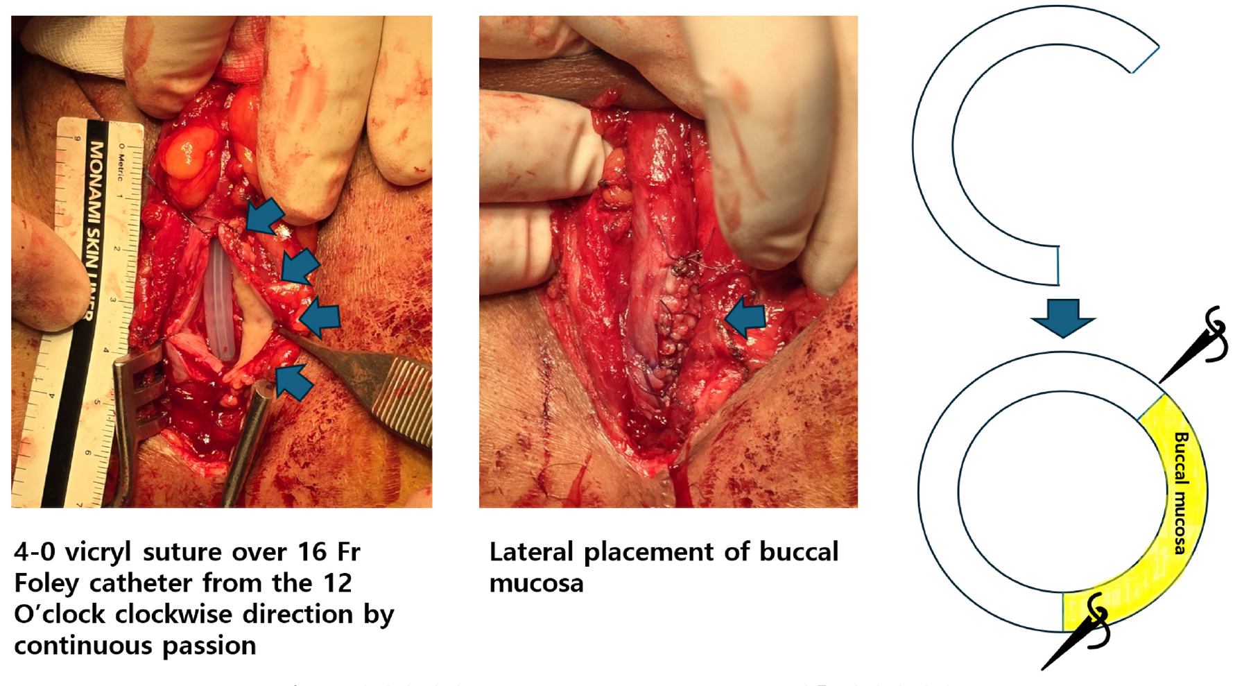 https://cdn.apub.kr/journalsite/sites/urology/2025-006-01/N0050060105/images/urology_06_01_05_F7.jpg