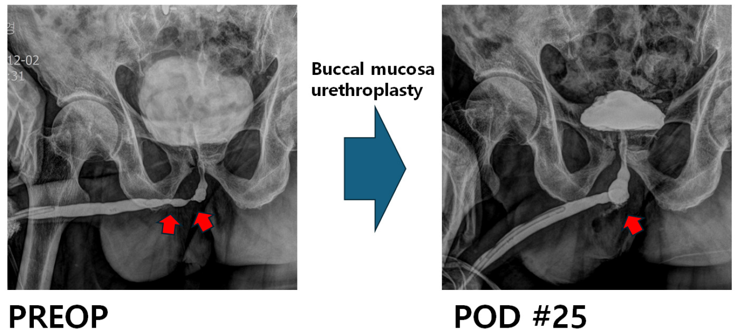 https://cdn.apub.kr/journalsite/sites/urology/2025-006-01/N0050060105/images/urology_06_01_05_F8.jpg