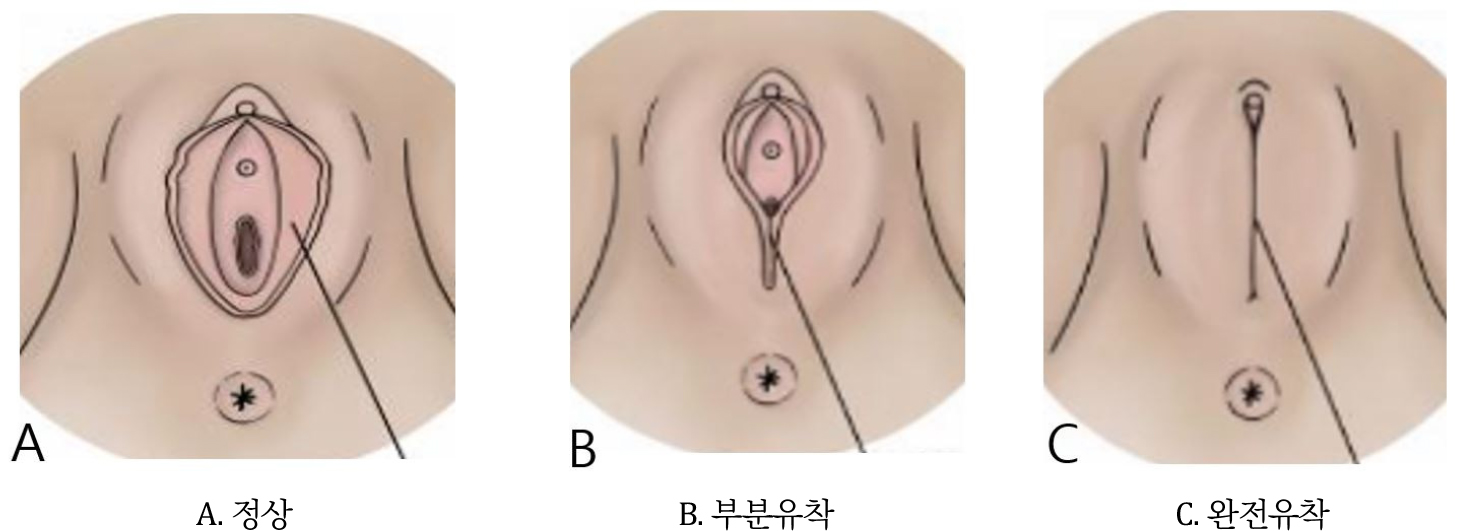 https://cdn.apub.kr/journalsite/sites/urology/2025-006-04/N0050060402/images/urology_06_04_02_F3.jpg